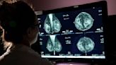 Expert panel that sparked mammogram controversy now says tests should start at 40