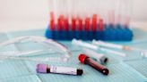 Prostate cancer blood test equally effective across ethnic groups