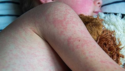 Measles cases in US are up in 2024. What's driving the increase?