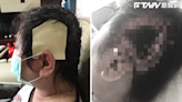 美容院竟用「電鍋」燙髮！女變禿頭、耳廓畸型 設計師判賠近20萬