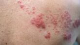 CDC: 1 in every 3 people will have Shingles in their lifetime. Do you know your risk?