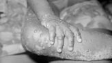 Number of monkeypox cases in UK rises to 57