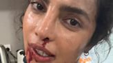 Priyanka Chopra is bruised and bloody for Russo brothers' The Bluff