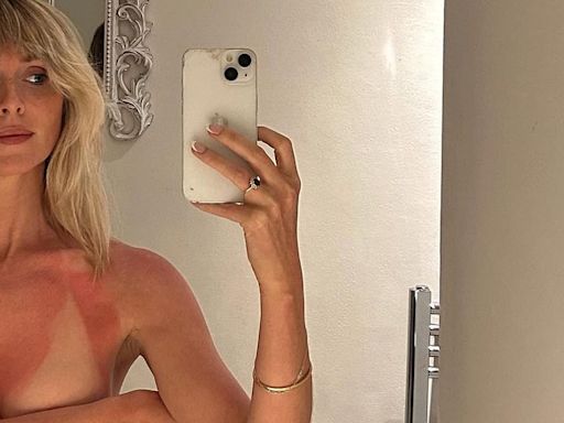 Diana Vickers goes topless as she displays her very sunburnt chest