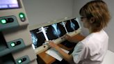 US panel drops mammography screening age back to 40