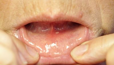 Mouth Ulcer (Canker Sore): Everything You Need to Know