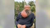 Giant tumor growing for decades removed from neck area of Scottsdale man