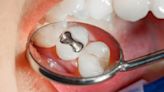 La Nación / UE prohíbe utilización de mercurio en amalgamas dentales