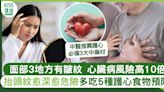 心臟檢查|面部3地方有皺紋 心臟病風險高10倍+5種護心食物 | 50+人士健康 | Sundaykiss 香港親子育兒資訊共享平台