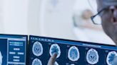 Brasileira consulta ChatGPT e descobre tumor no cérebro; entenda a história