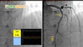 心血管狹窄一定要放支架嗎？ 精準檢測免除不必要的風險
