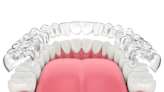 How Does Invisalign Work Step by Step?