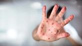 2 cases of measles confirmed in Clackamas County; Oregon health officials say there could be more, unreported cases