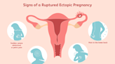 What To Know About Ruptured Ectopic Pregnancy