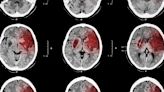 Late-Window Tenecteplase for Stroke Works When Thrombectomy's Out of the Question