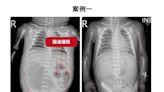 迴腸閉鎖、腸扭轉嚴重穿孔 台中女嬰出生2日開刀搶命