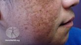 US Study Delves Into Risk Factors for Melasma