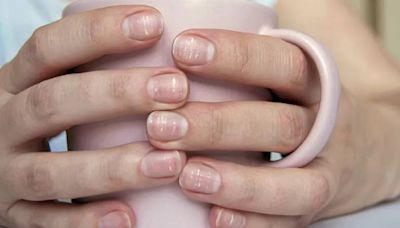 Elimine las manchas blancas en las uñas con estos dos ingredientes de cocina