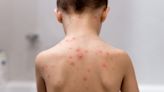 More than 90% of chickenpox cases in New York City outbreak among unvaccinated people