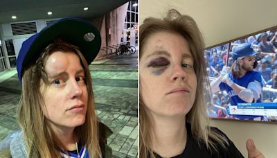A fan hit by a foul ball stayed through the 9th. Now she’s on a baseball card.