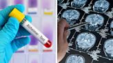 Groundbreaking Blood Test Could Hold Key to Diagnosing Alzheimer’s Disease Faster And More Accurately, Says Study