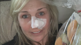 Colorado woman warns of skin cancer dangers after facial reconstructive surgery