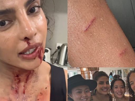 Priyanka Chopra Says Doing Action Movies Is ‘Glamorous’; Shares Her Injuries, Blood-Stained Videos - News18