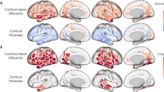 Spatial pattern of pathological changes in the brain can help identify dementia vulnerability early