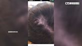 女染髮後頭皮異常腫痛 「狂落髮」韓國行慘毀