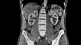 Abdominal CT Scan: What’s Diagnosed?