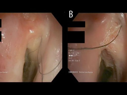 Austrian man, who smoked cigarettes for 30 years, developed hair inside throat. Then…