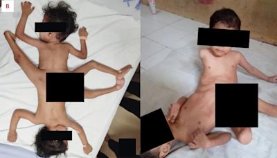 印尼「蜘蛛連體嬰」共用陰莖 切除「第3條腿」奇蹟存活