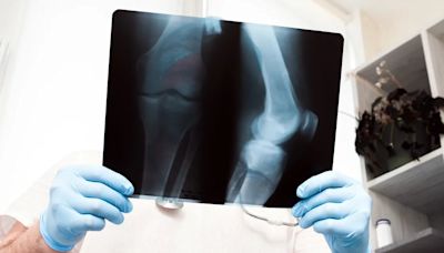 Estas son las fracturas de huesos más comunes según la edad y su tiempo de recuperación