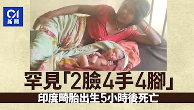 印度婦誕畸胎「2臉4手4腳」 出生僅5小時死亡原因慘痛