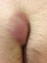 Pilonidal disease