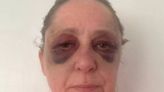 Scottish gran beaten black and blue by feral gang while sunbathing at beauty spot