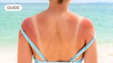 How to prevent and treat sunburn