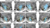 New deep brain stimulation algorithm may help personalize Parkinson's disease treatment