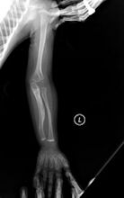 Osteogenesis imperfecta