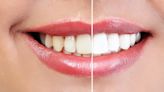 This Teeth Whitening Prewash May Leave You 6 Shades Lighter in 5 Days