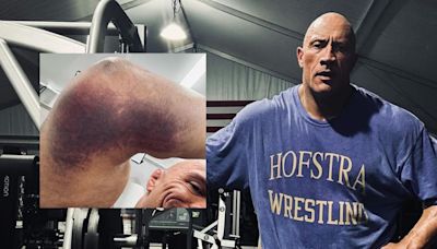 Dwayne Johnson shows massive elbow bruise from ‘The Smashing Machine’ injury, says he is ‘back to work’