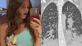 Así quedaron los pulmones de una mujer de 19 años luego de utilizar el vaper de su novio durante un mes