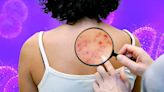 Can you tell the harmless rash from the fatal? Pharmacist reveals vital clues