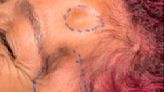 Médicos argentinos reparan por primera vez con lipotransferencia las huellas que dejan las cirugías de cerebro en el rostro
