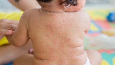 新生兒常見的「玫瑰疹」很可怕嗎？好發年齡、症狀與預防照護一次看 - The News Lens 關鍵評論網