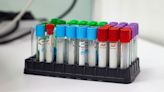 Urine Test Detects DNA Released by Head and Neck Tumors