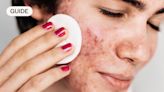 How to treat adult acne: causes, treatments and steps to prevent it