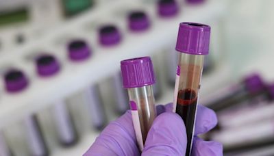Una alternativa a la colonoscopía: FDA aprueba test de sangre para detectar cáncer de colon - La Tercera