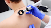 Melanoma Awareness Month: how to identify abnormal features