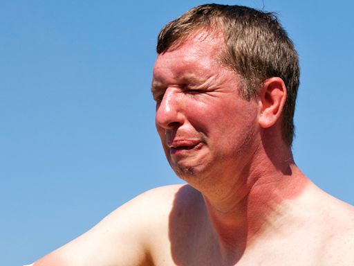 My unorthodox trick will drastically reduce discomfort when you get a sunburn